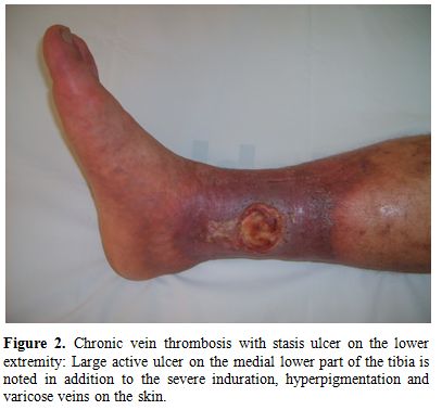 Venous Leg Ulceration Charlotte | Gastonia NC Venous Leg Ulceration Charlotte | Gastonia NC