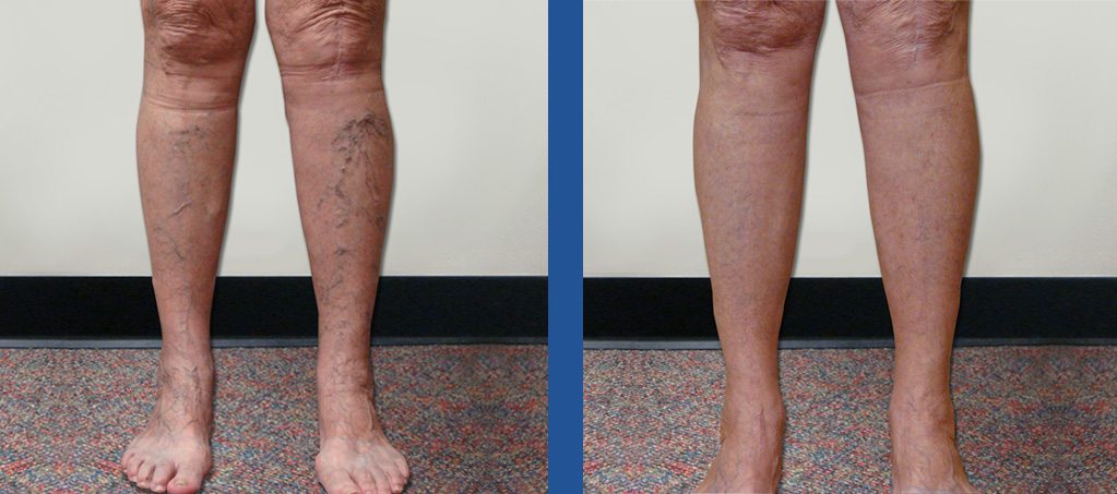Vein Treatment Before and After Photos | Charlotte