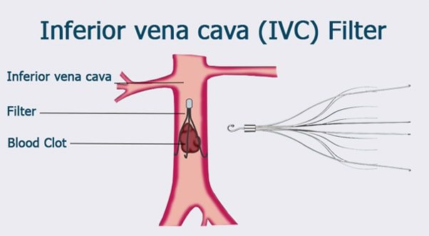 Inferior Vena Cava Filter (IVC Filter), Vein Specialists of the Carolinas Inferior Vena Cava Filter (IVC Filter), Vein Specialists of the Carolinas
