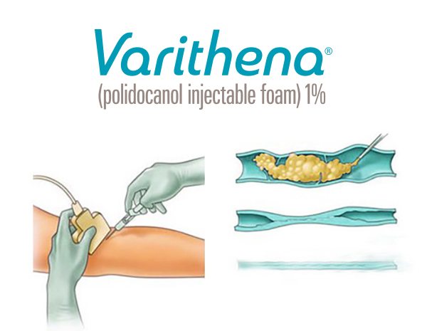 Varithena, Vein Specialists of the Carolinas Varithena, Vein Specialists of the Carolinas