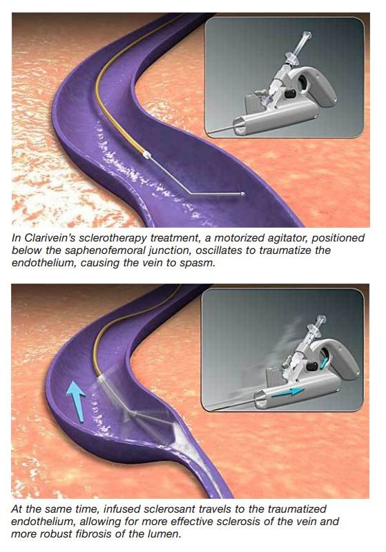 Clarivein, Vein Specialists of the Carolinas Clarivein, Vein Specialists of the Carolinas