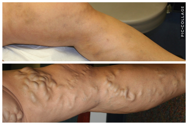 Varicose Veins, Vein Specialists of the Carolinas Varicose Veins, Vein Specialists of the Carolinas