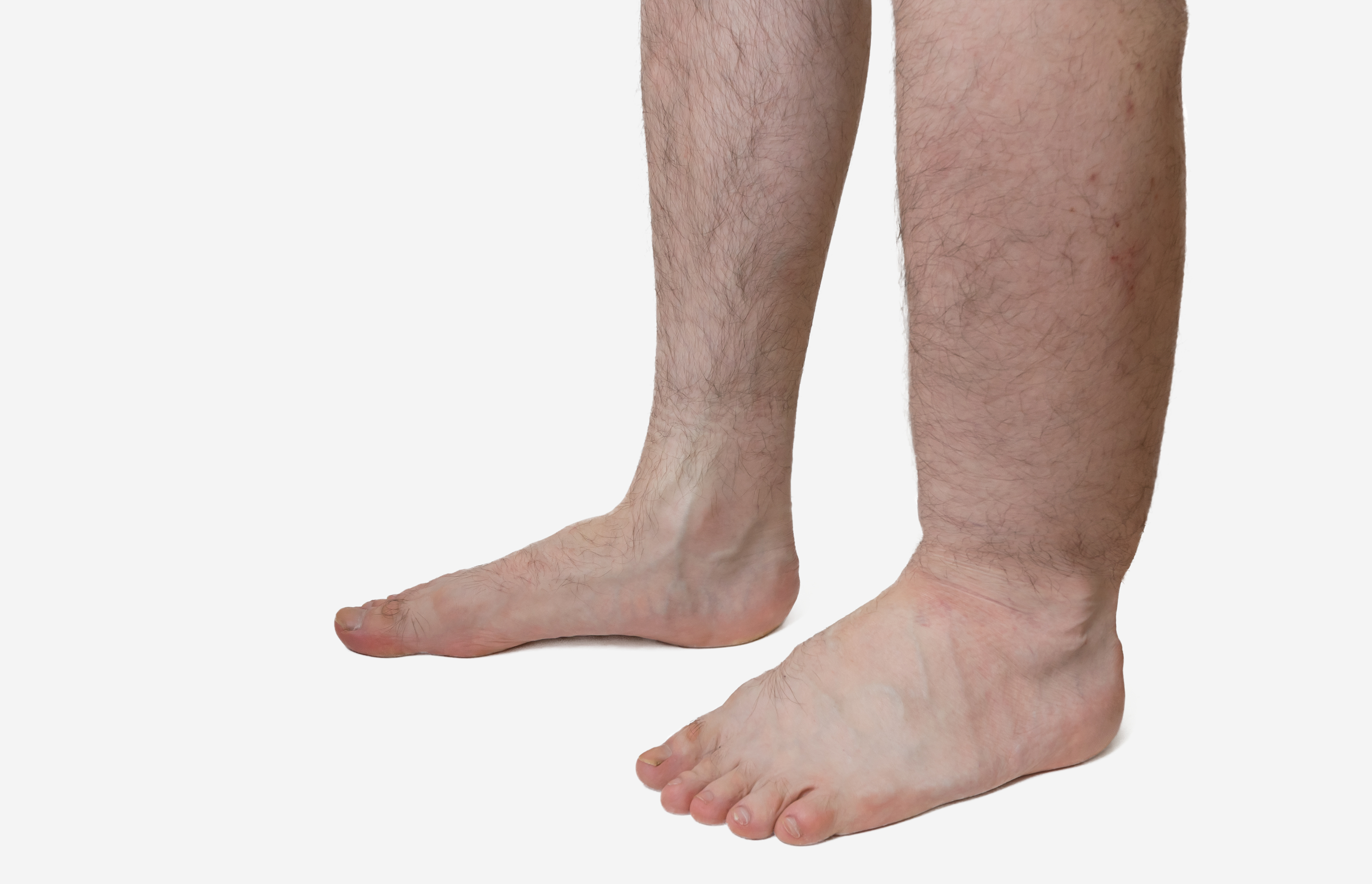 Vein Disorders, Vein Specialists of the Carolinas Vein Disorders, Vein Specialists of the Carolinas