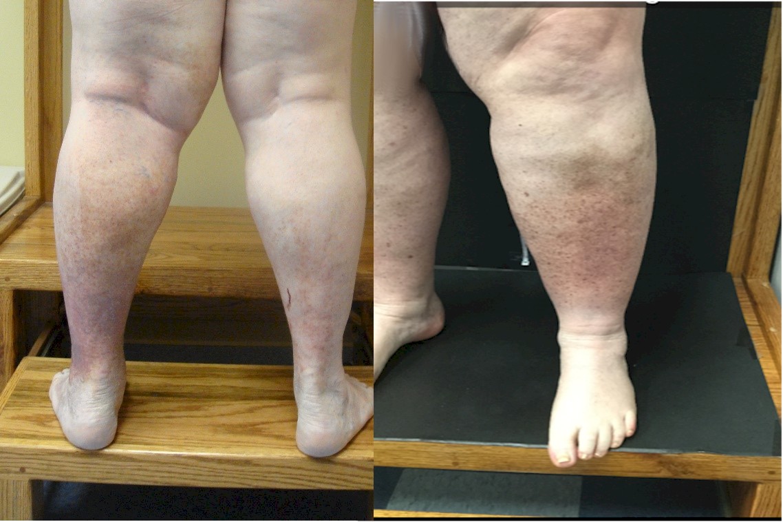 Chronic Venous Insufficiency, Vein Specialists of the Carolinas