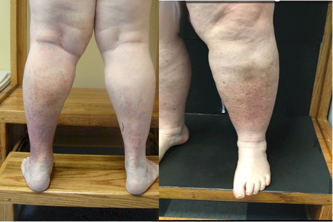Chronic Venous Insufficiency, Vein Specialists of the Carolinas Chronic Venous Insufficiency, Vein Specialists of the Carolinas