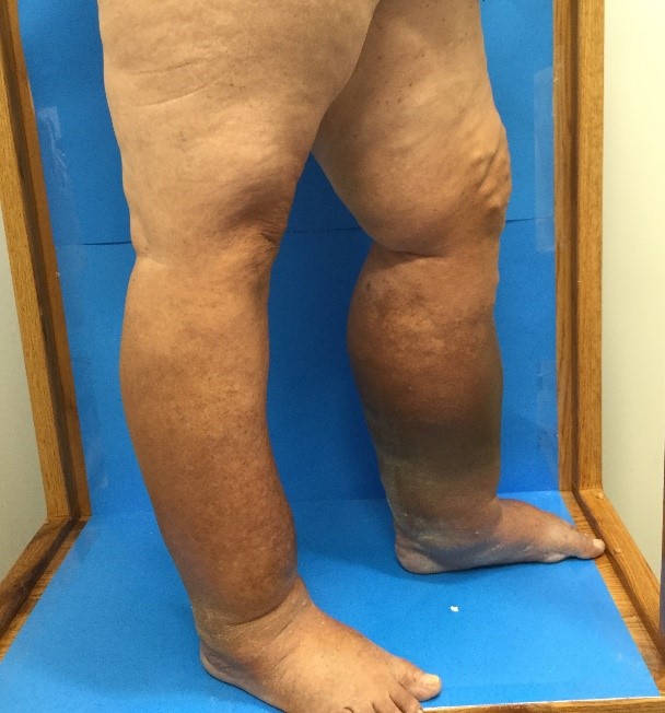 Chronic Venous Insufficiency, Vein Specialists of the Carolinas