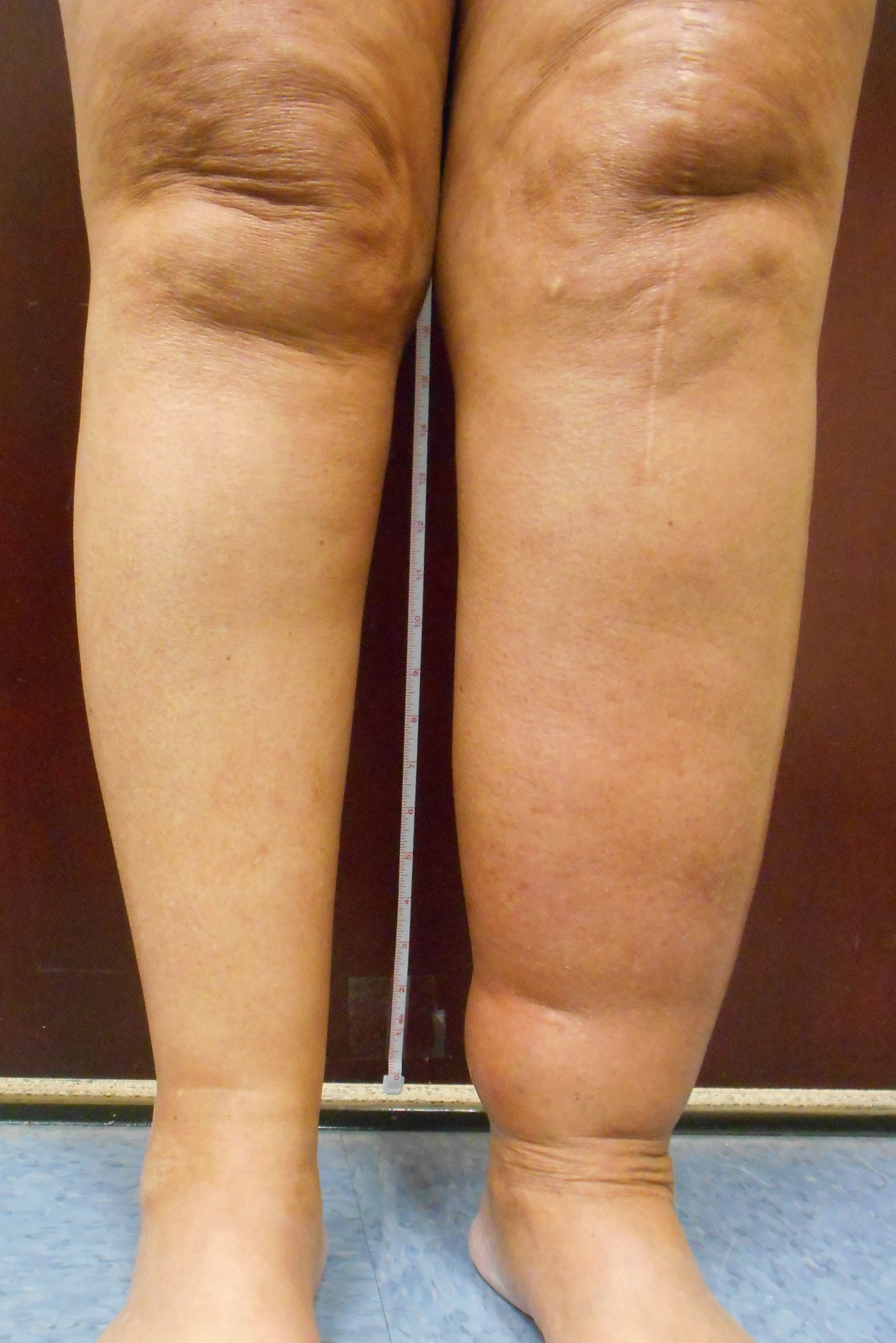 May Thurner Syndrome, Vein Specialists of the Carolinas