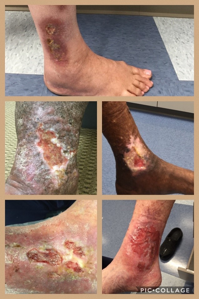 Venous Leg Ulceration, Vein Specialists of the Carolinas