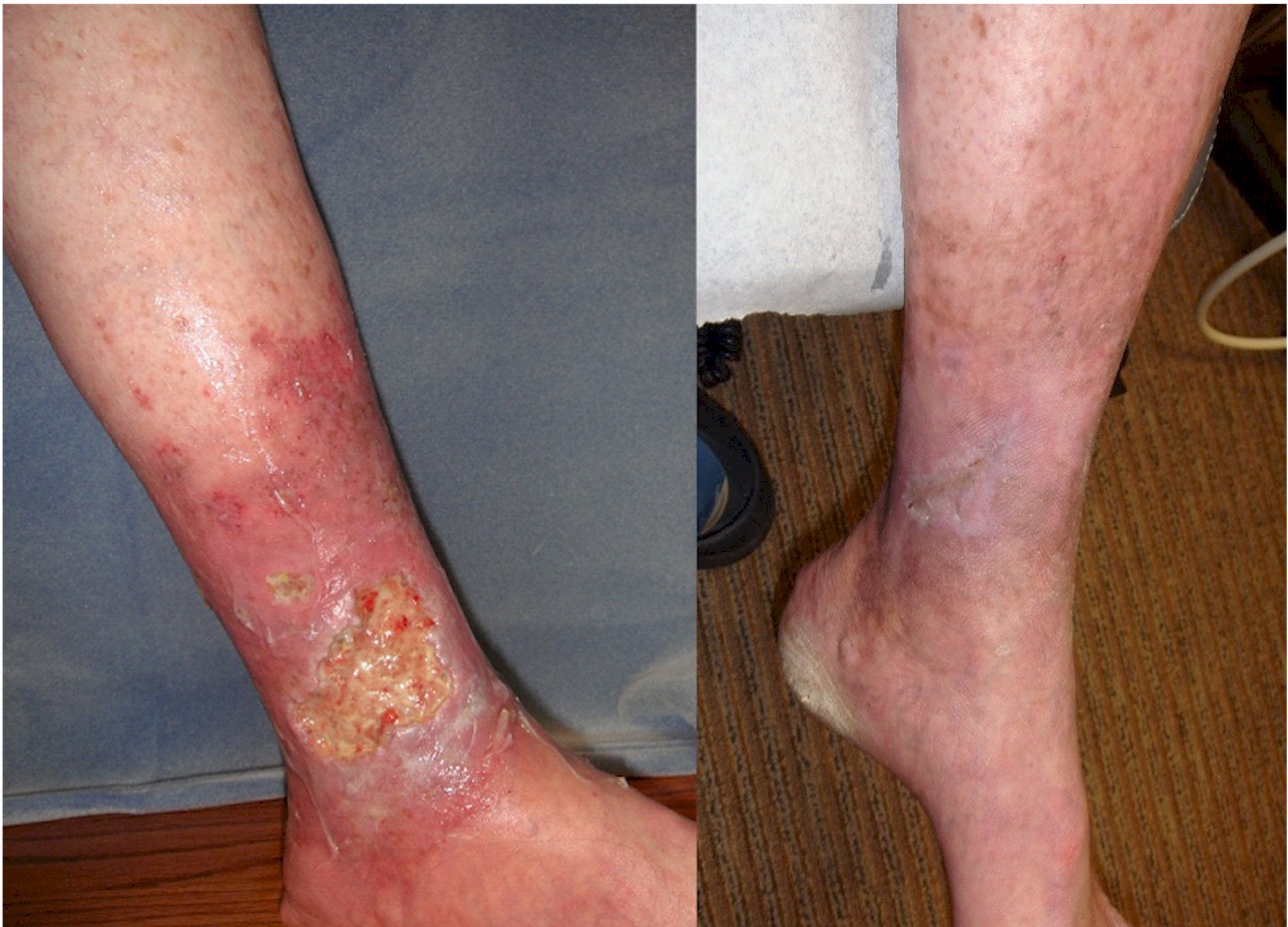 Venous Leg Ulceration, Vein Specialists of the Carolinas Venous Leg Ulceration, Vein Specialists of the Carolinas