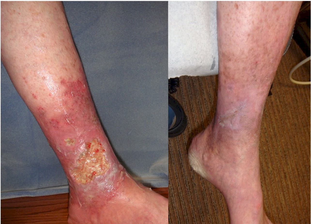 Venous Insufficiency &#8211; The Most Common Cause Of Lower-Leg Ulcers, Vein Specialists of the Carolinas