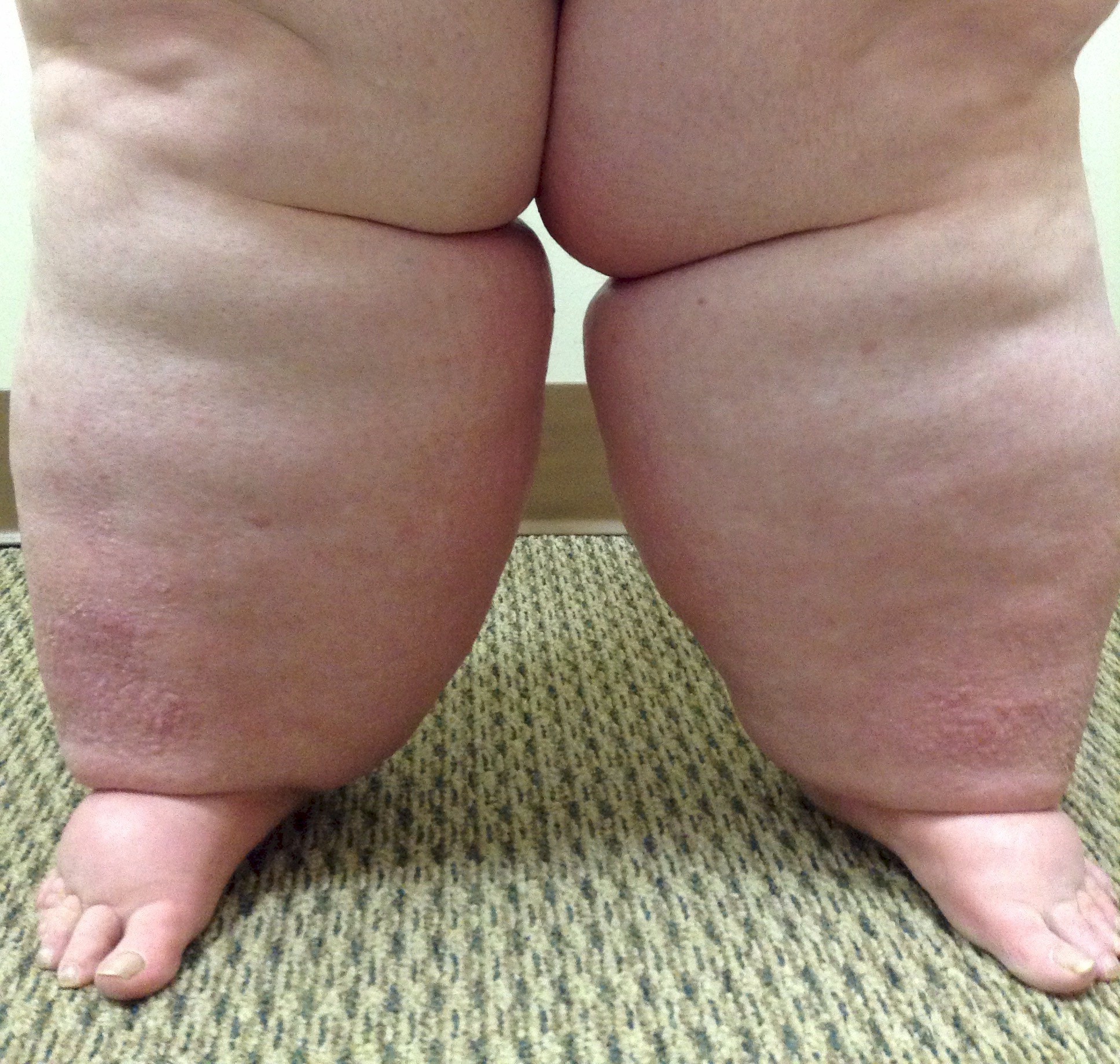 Lymphedema, Vein Specialists of the Carolinas Lymphedema, Vein Specialists of the Carolinas