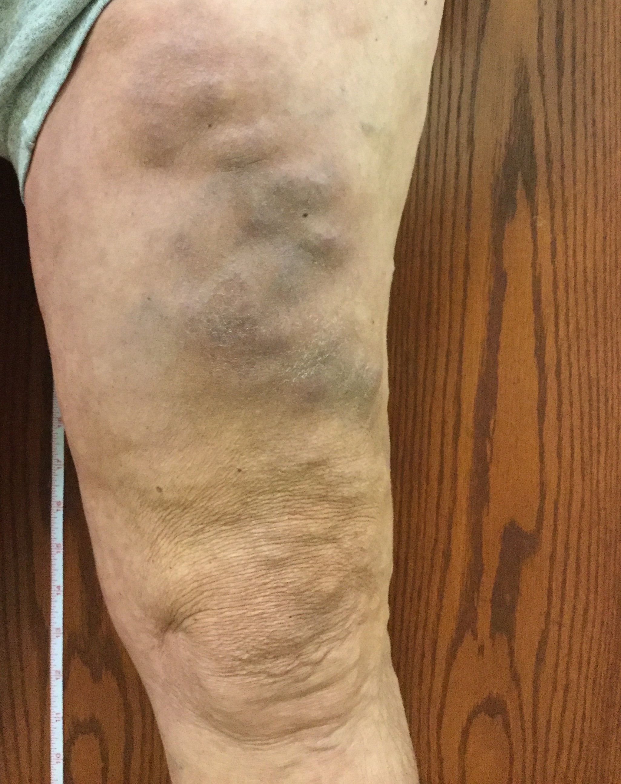 Phlebitis &#8211; Vein Disorders, Vein Specialists of the Carolinas