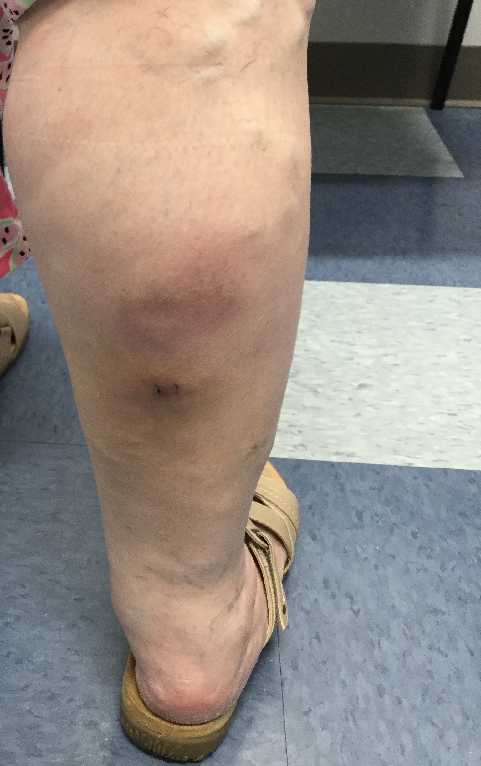 Phlebitis – Vein Disorders, Vein Specialists of the Carolinas Phlebitis – Vein Disorders, Vein Specialists of the Carolinas