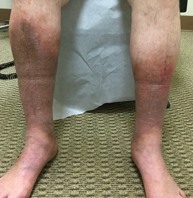 Chronic Venous Insufficiency Vein Disorders Vein Specialists Of Carolinas