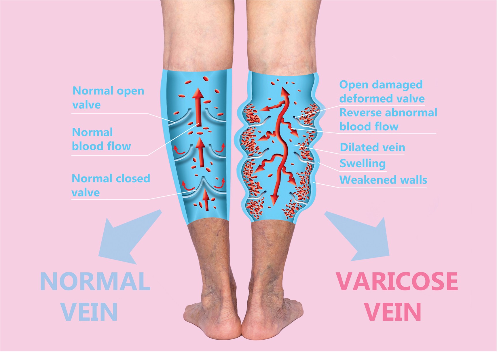 All Vein Procedures Are Designed To Help The Veins Empty The Tissues. Some procedures destroy veins and some open them up. This seems contradictory.