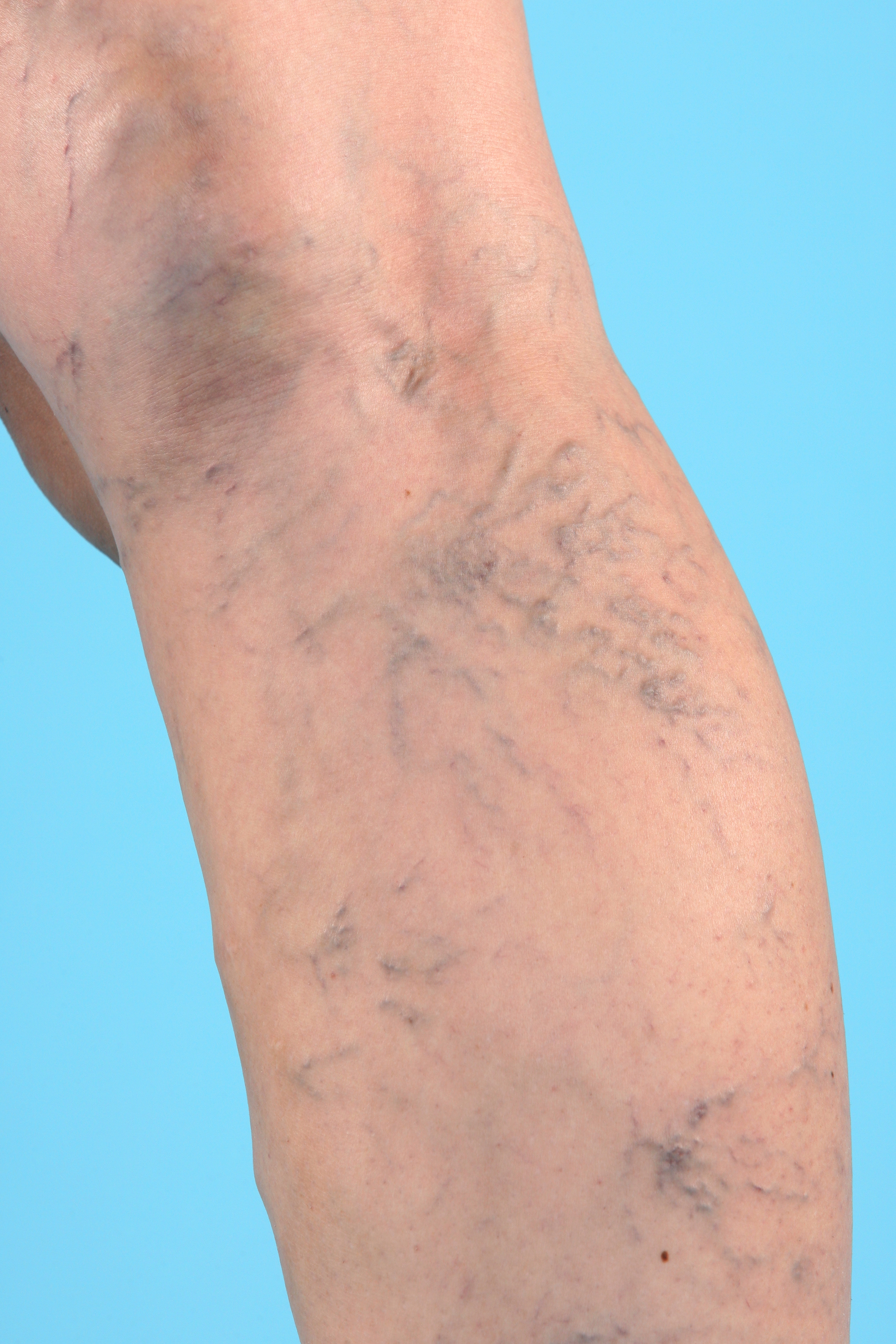 Vein Disorders, Vein Specialists of the Carolinas