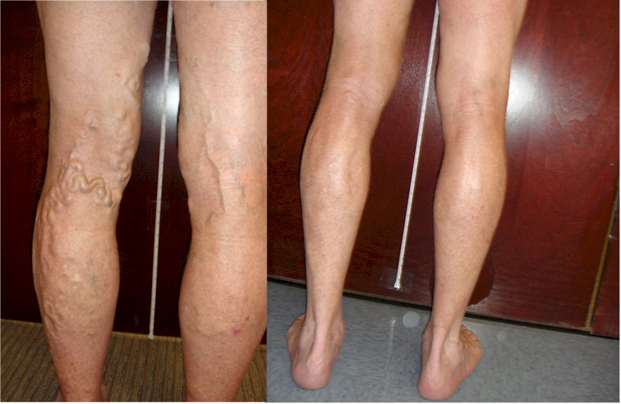 Before and After Picture of Vein Procedure - Vein Specialists of the Carolinas