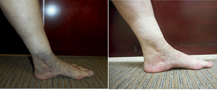 Vein Disorders, Vein Specialists of the Carolinas Vein Disorders, Vein Specialists of the Carolinas
