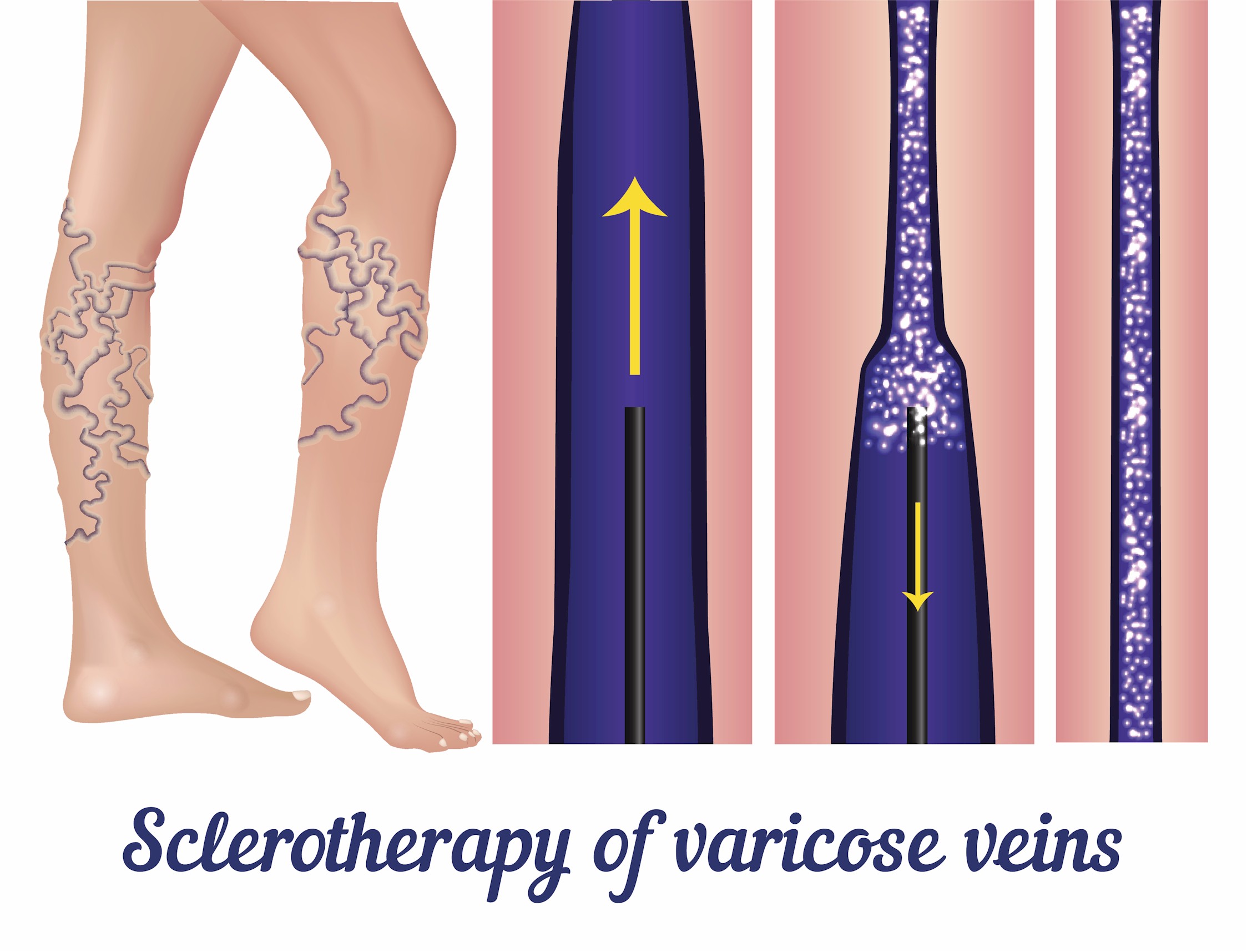 Sclerotherapy, Vein Specialists of the Carolinas
