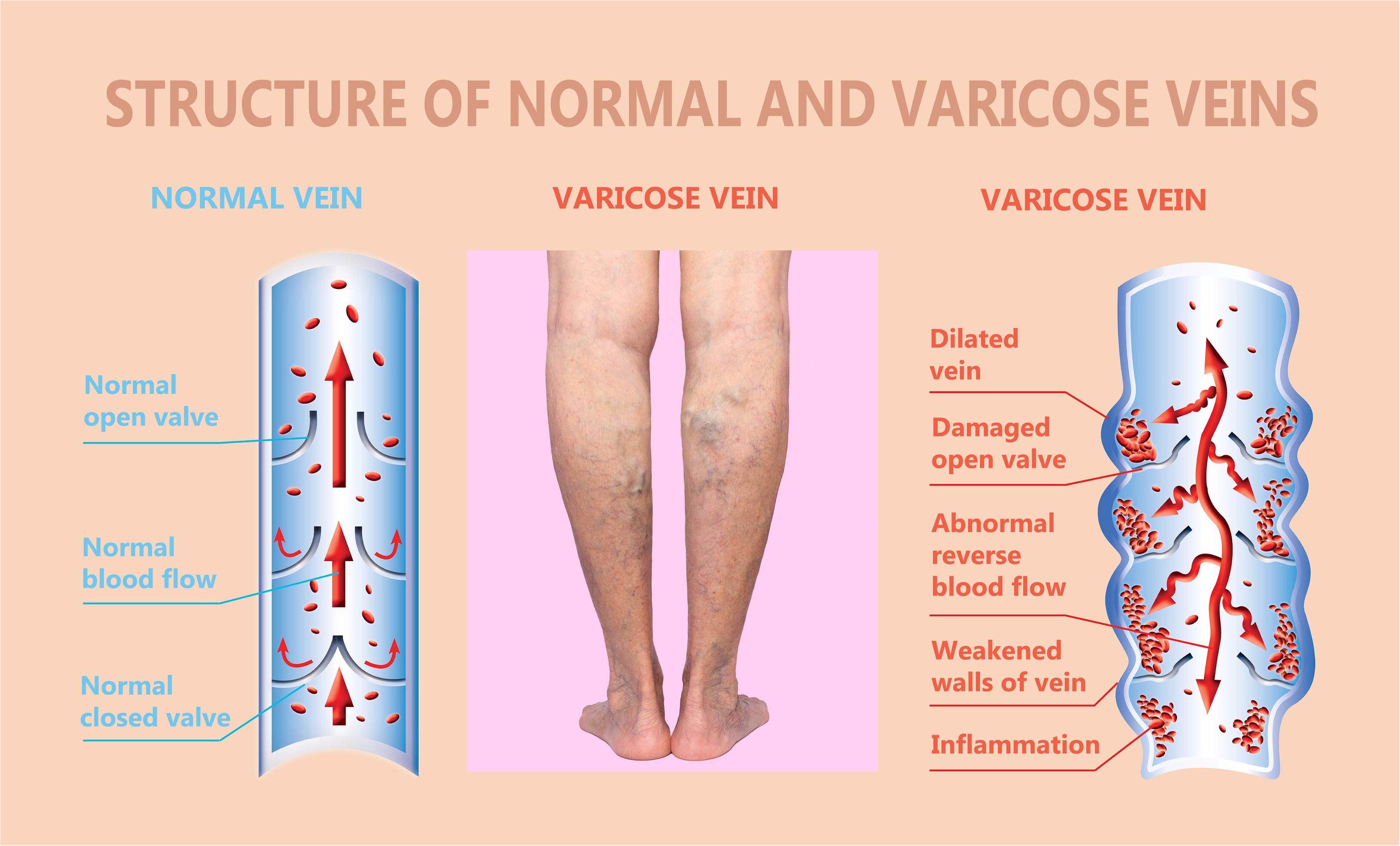 Vein Disorders, Vein Specialists of the Carolinas