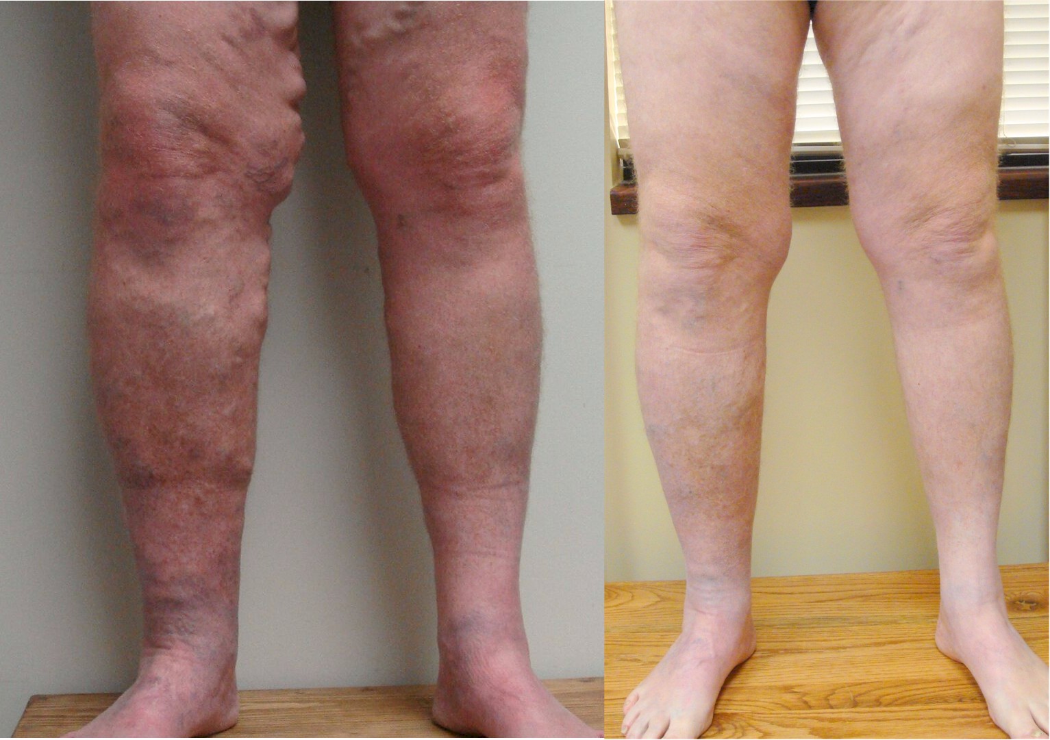 Before and After Picture of Varicose Vein Procedure - Vein Specialists of the Carolinas