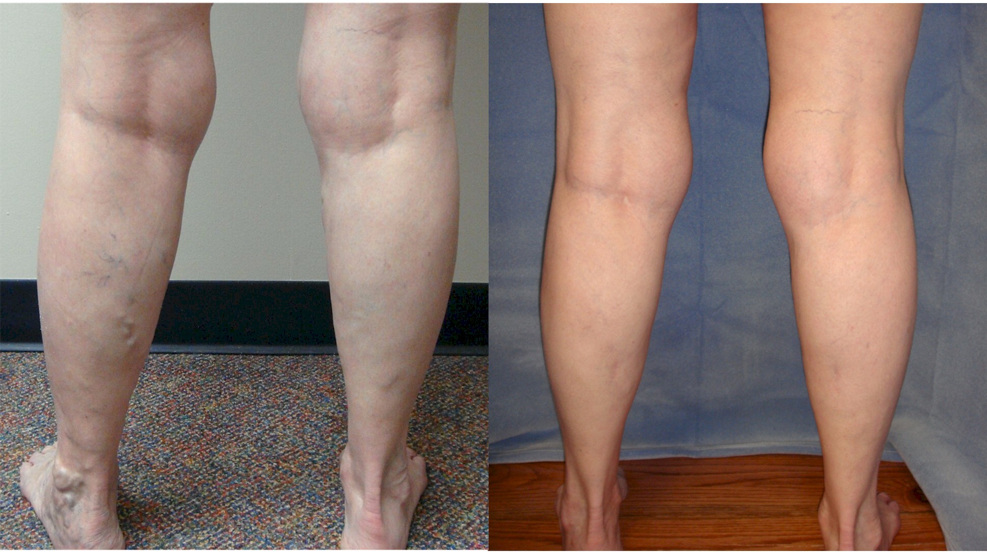 Before and After Picture of Varicose Vein Procedure - Vein Specialists of the Carolinas