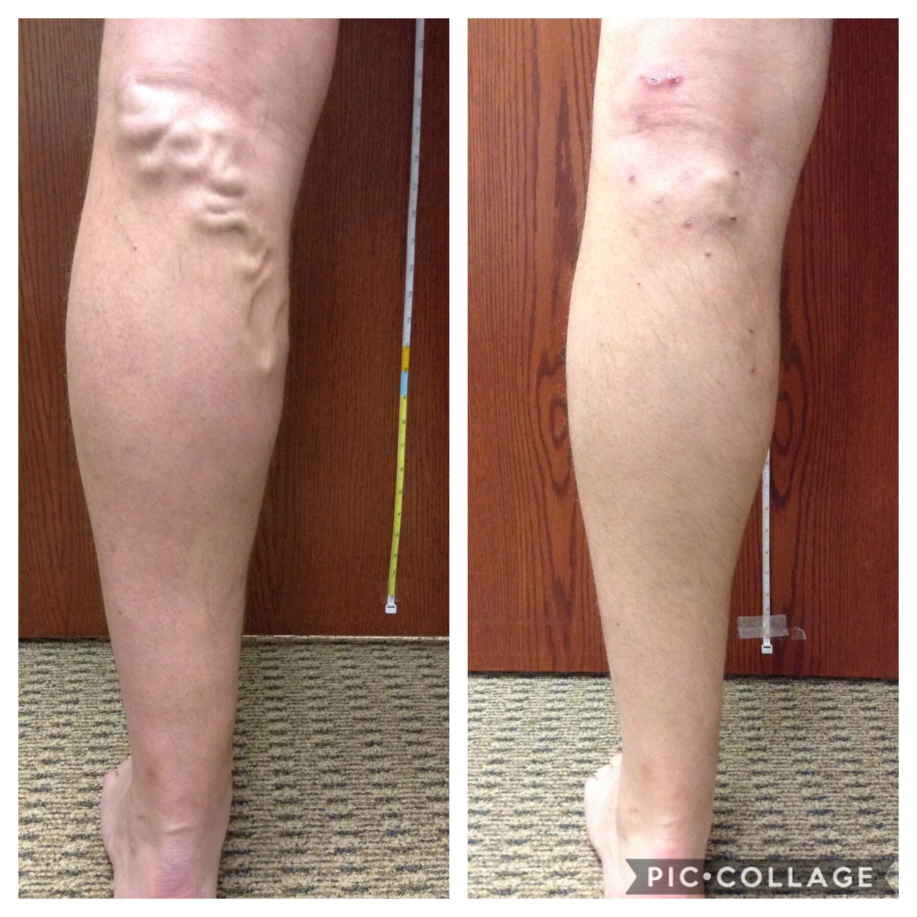 Before and After Vein Treatment Photos Vein Specialists of the Carolinas