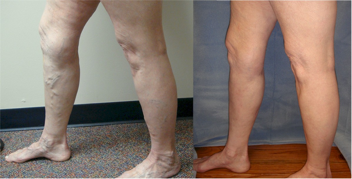 Varicose Veins, Vein Specialists of the Carolinas Varicose Veins, Vein Specialists of the Carolinas
