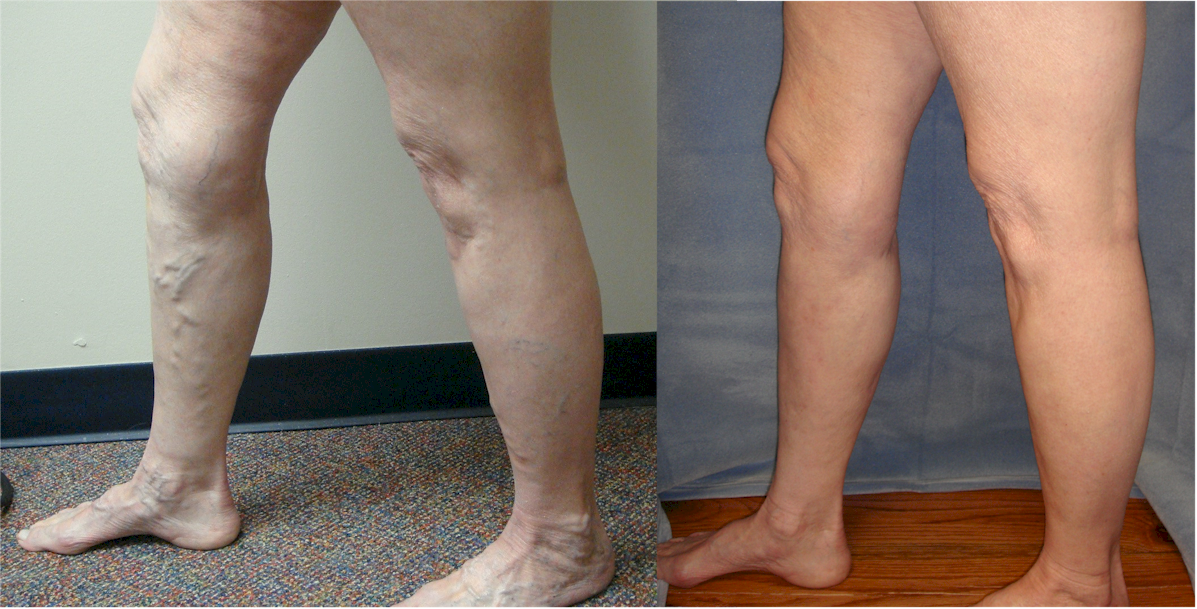 Varicose Veins Vein Specialists of the Carolinas