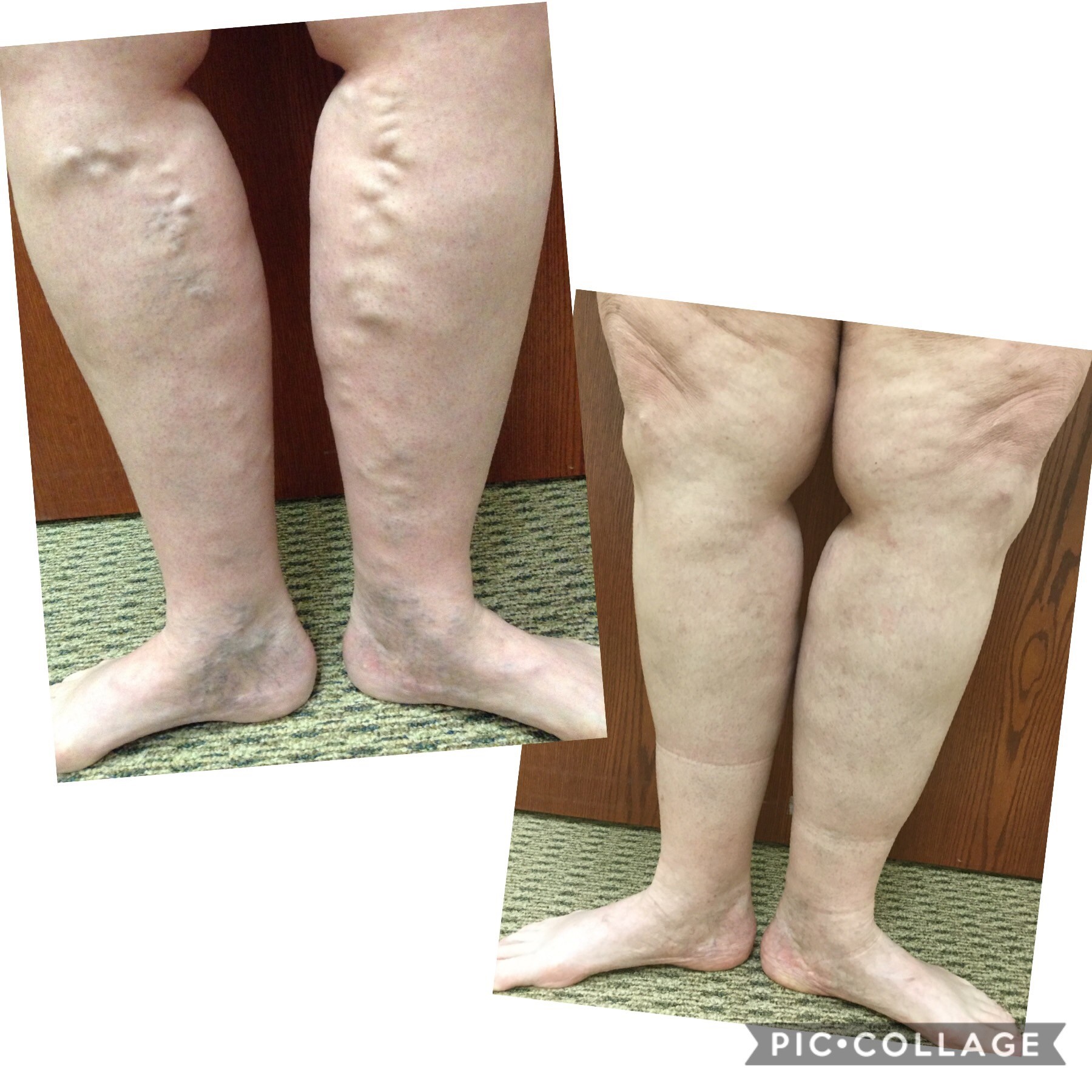 Radiofrequency Ablation, Vein Specialists of the Carolinas Radiofrequency Ablation, Vein Specialists of the Carolinas