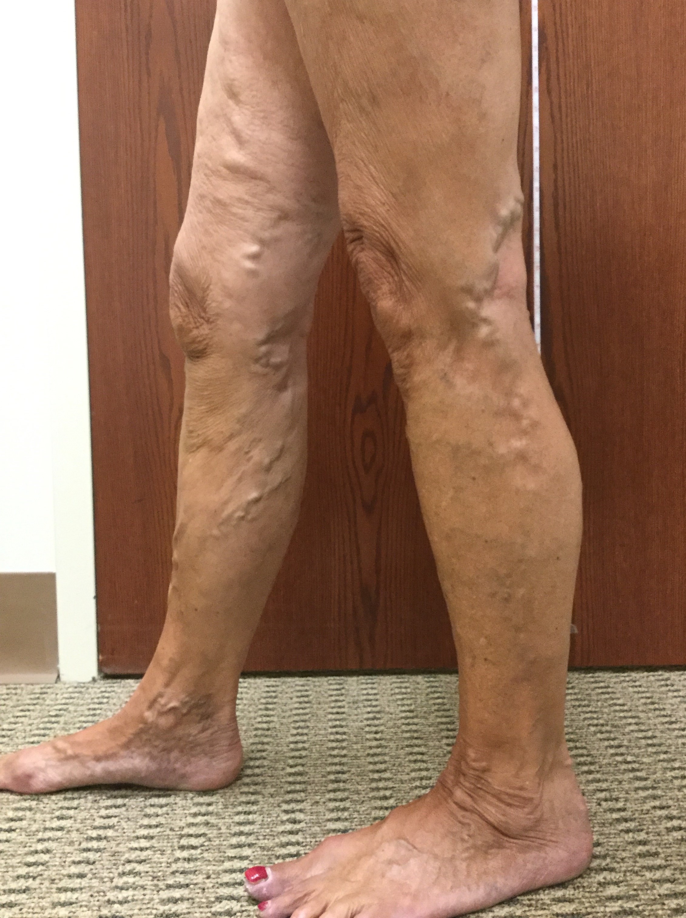 Vein Disorders, Vein Specialists of the Carolinas