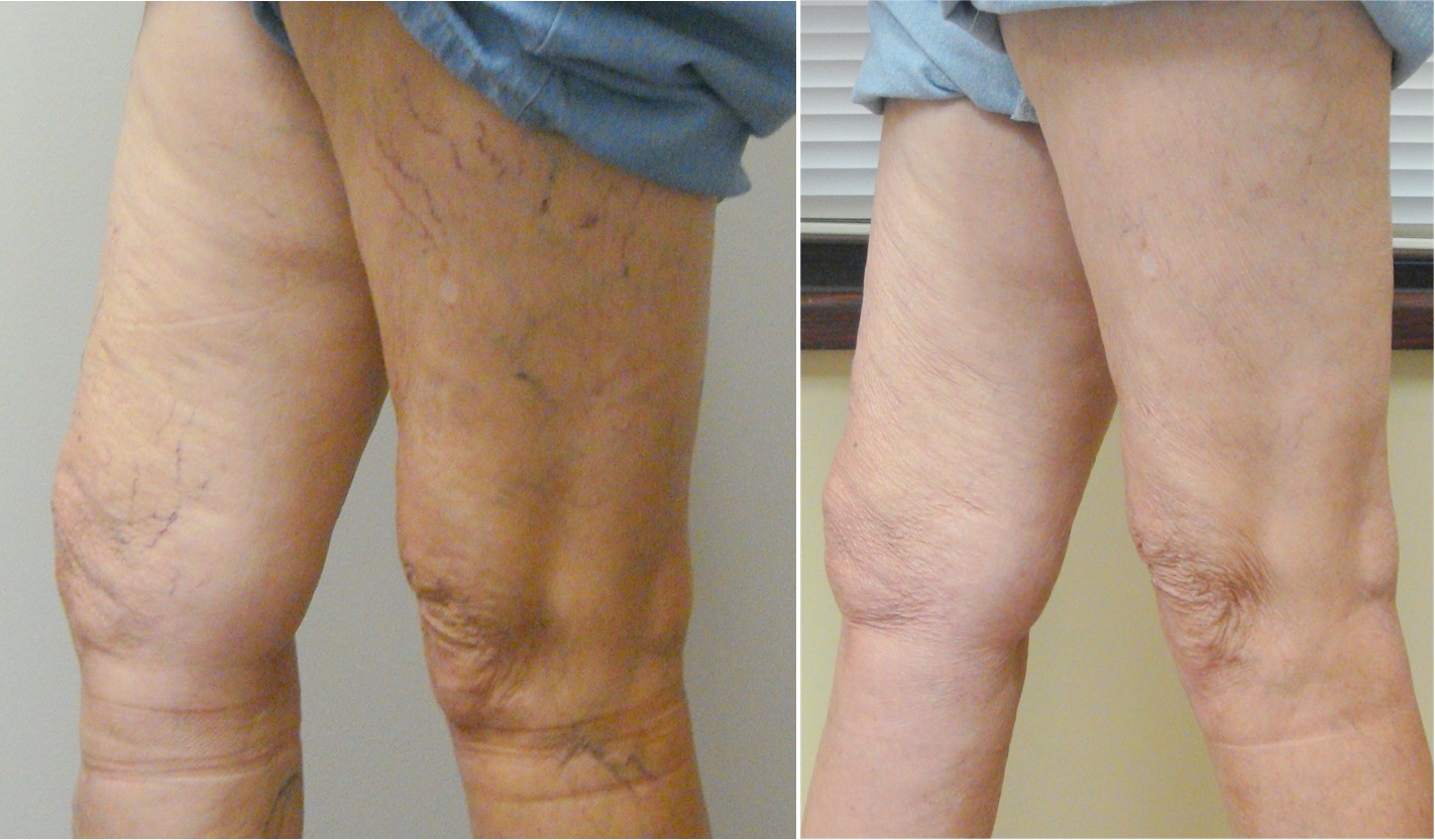 10% Off Sclerotherapy, Vein Specialists of the Carolinas