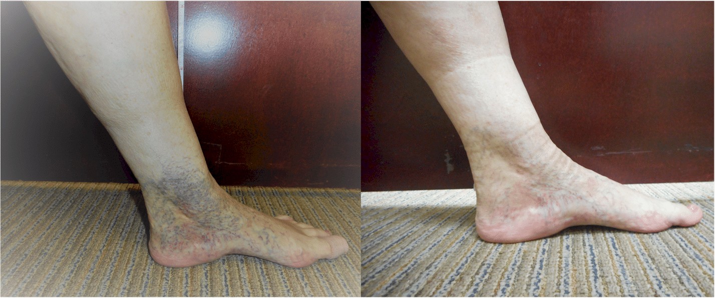 Sclerotherapy, Vein Specialists of the Carolinas Sclerotherapy, Vein Specialists of the Carolinas
