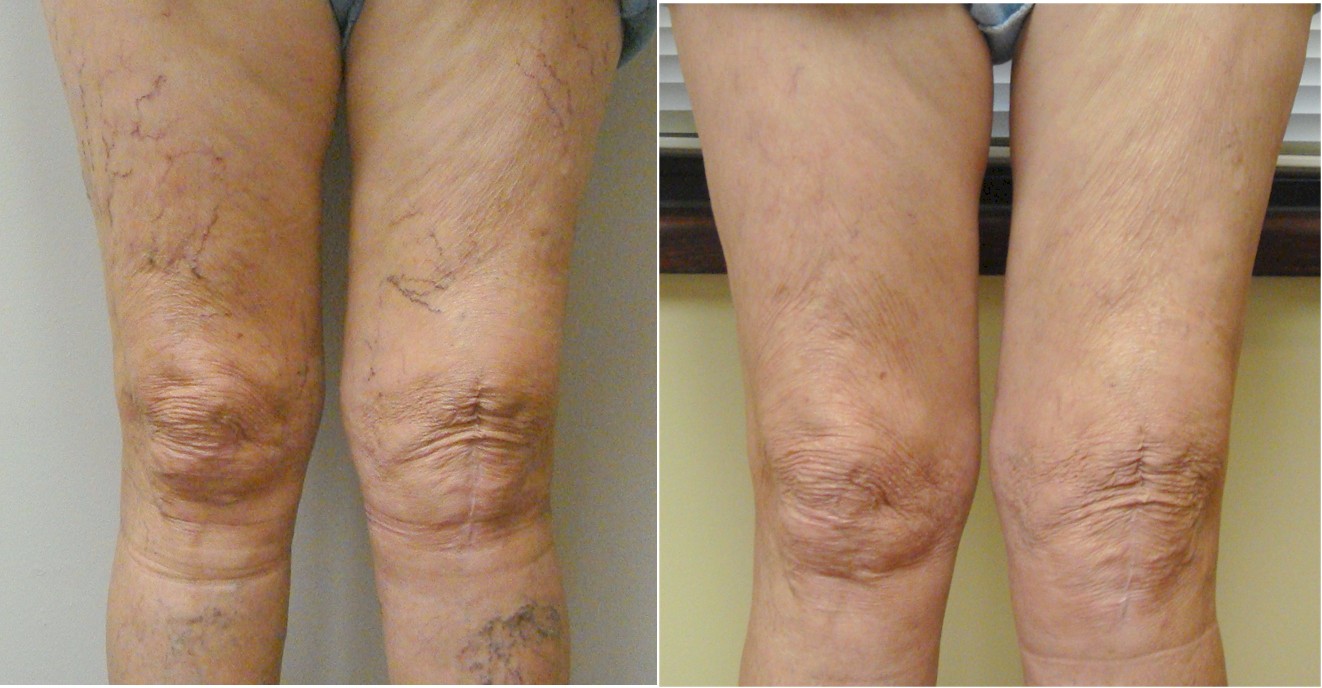 Sclerotherapy, Vein Specialists of the Carolinas