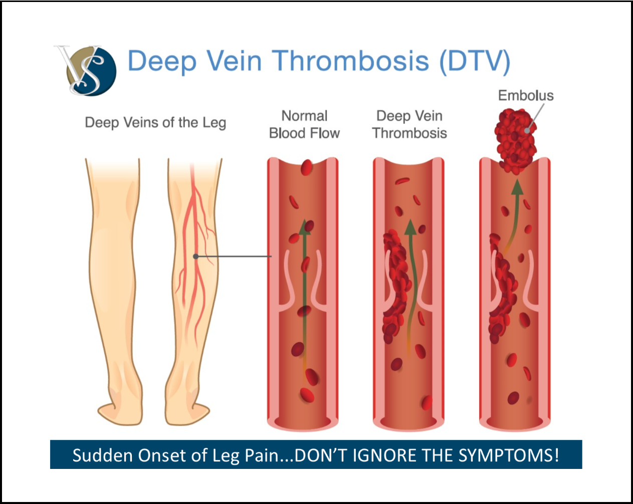 DVT “Deep Vein Thrombosis” Is Usually A Condition That Starts In The Leg…